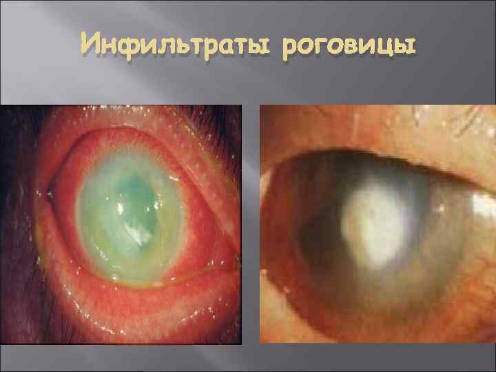 Инфильтраты роговицы 