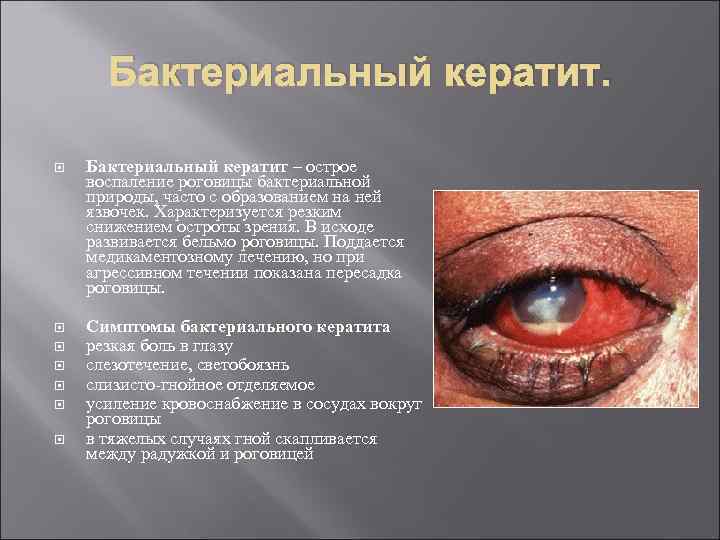 Бактериальный кератит – острое воспаление роговицы бактериальной природы, часто с образованием на ней язвочек.