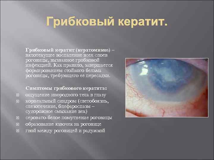 Грибковый кератит (кератомикоз) – вялотекущее воспаление всех слоев роговицы, вызванное грибковой инфекцией. Как правило,