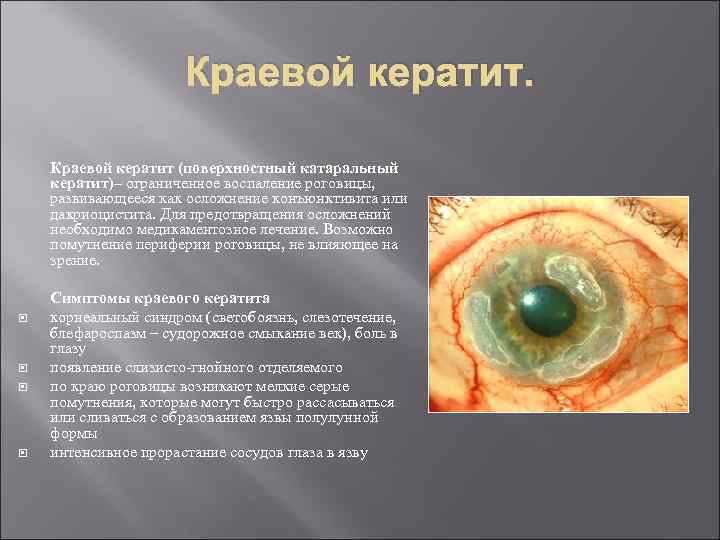 Краевой кератит (поверхностный катаральный кератит)– ограниченное воспаление роговицы, развивающееся как осложнение конъюнктивита или дакриоцистита.