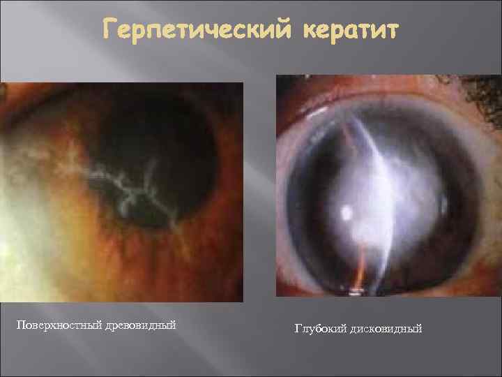 Поверхностный древовидный Глубокий дисковидный 