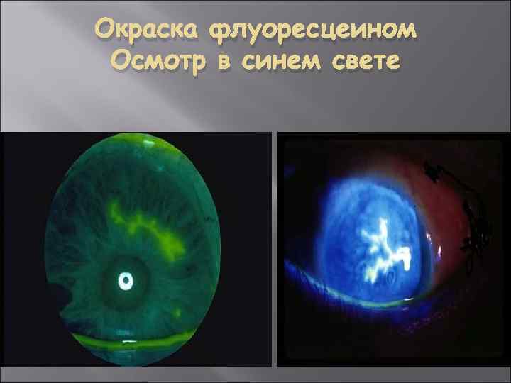 Окраска флуоресцеином Осмотр в синем свете 