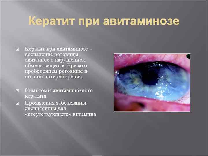 Кератит при авитаминозе – воспаление роговицы, связанное с нарушением обмена веществ. Чревато прободением роговицы