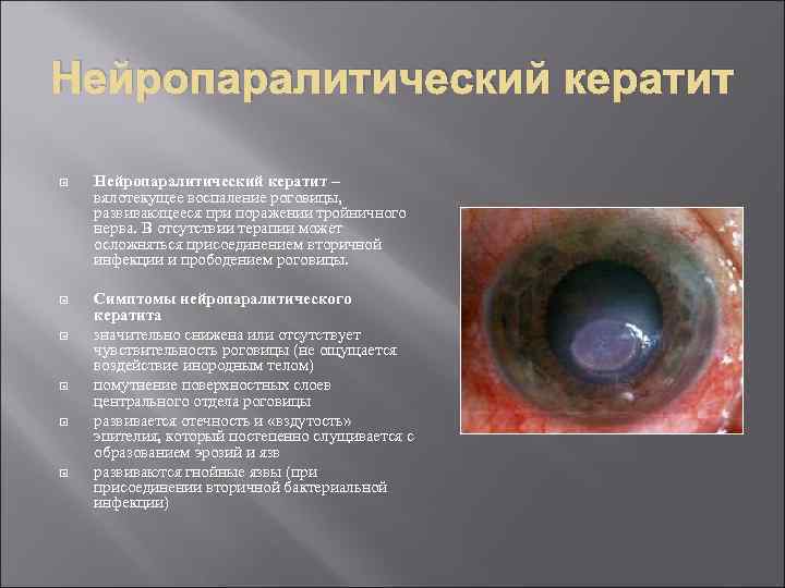 Нейропаралитический кератит – вялотекущее воспаление роговицы, развивающееся при поражении тройничного нерва. В отсутствии терапии