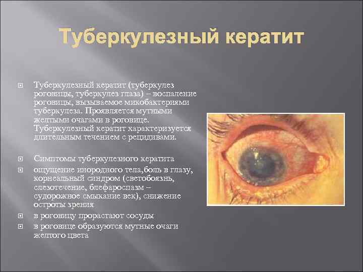 Туберкулезный кератит (туберкулез роговицы, туберкулез глаза) – воспаление роговицы, вызываемое микобактериями туберкулеза. Проявляется мутными