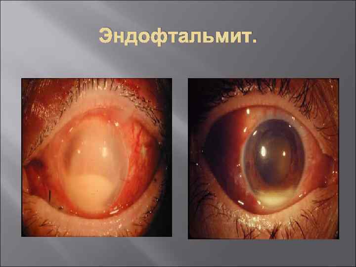 Эндофтальмит. 