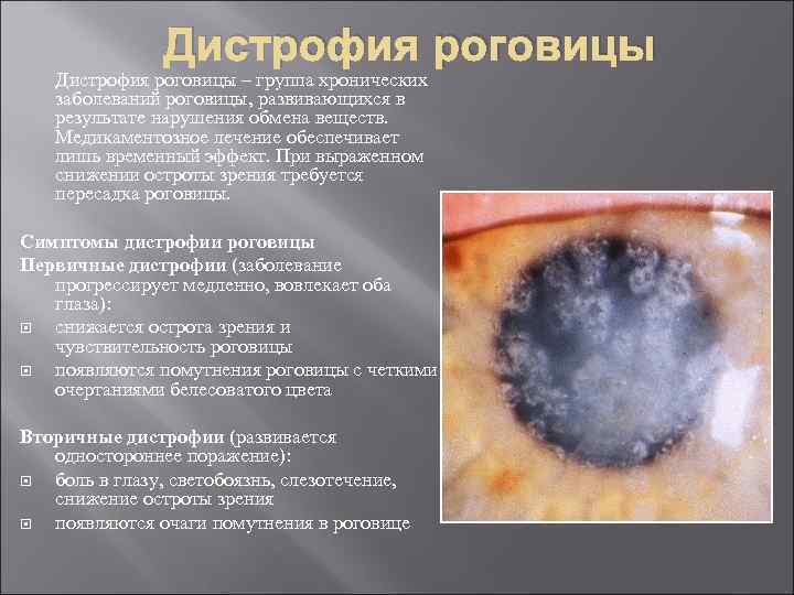 Дистрофия роговицы – группа хронических заболеваний роговицы, развивающихся в результате нарушения обмена веществ. Медикаментозное