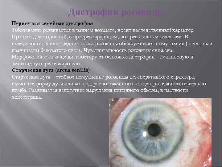 Дистрофии роговицы Первичная семейная дистрофия Заболевание развивается в раннем возрасте, носит наследственный характер. Процесс