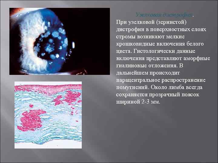 Узелковая дистрофия. При узелковой (зернистой) дистрофии в поверхностных слоях стромы возникают мелкие крошковидные включения
