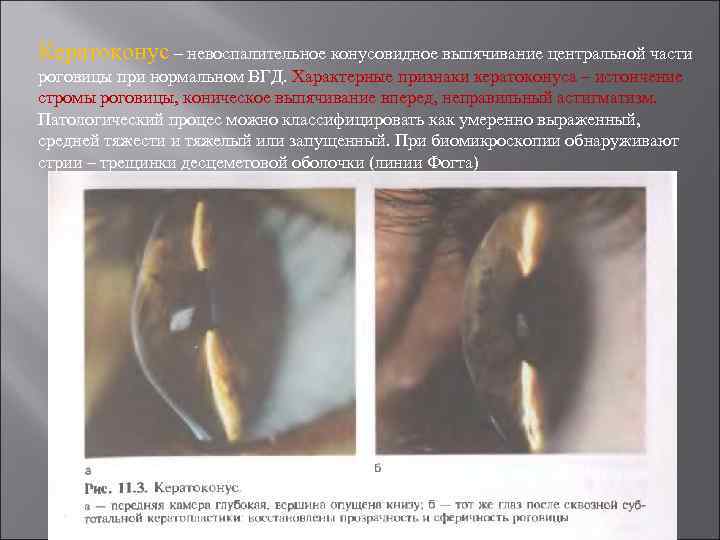 Кератоконус – невоспалительное конусовидное выпячивание центральной части роговицы при нормальном ВГД. Характерные признаки кератоконуса