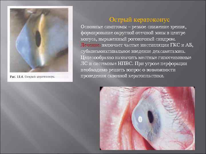 Острый кератоконус Основные симптомы – резкое снижение зрения, формирование округлой отечной зоны в центре