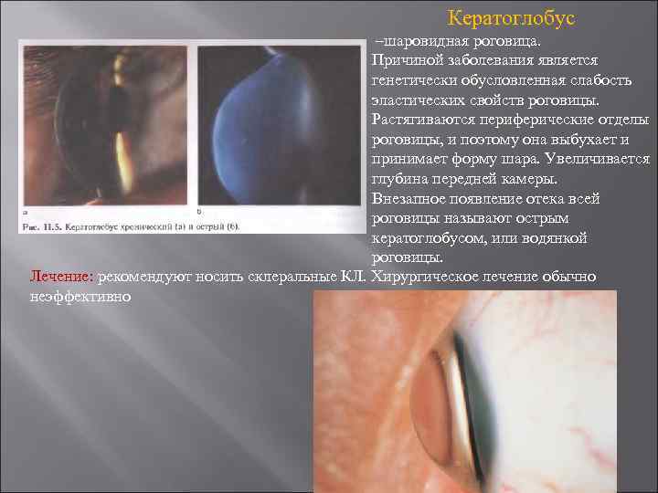 Кератоглобус –шаровидная роговица. Причиной заболевания является генетически обусловленная слабость эластических свойств роговицы. Растягиваются периферические