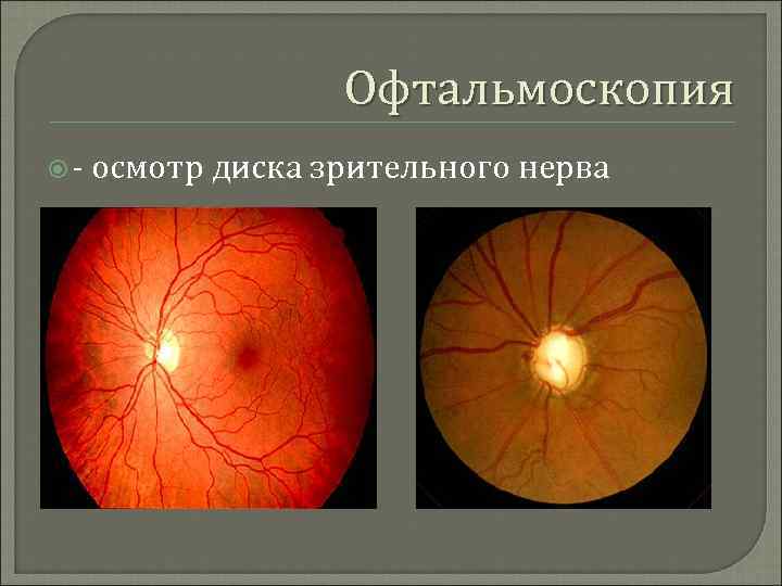 Офтальмоскопия осмотр диска зрительного нерва 