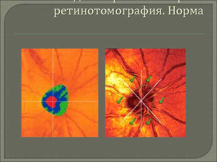 Гейдельбергская лазерная ретинотомография. Норма 