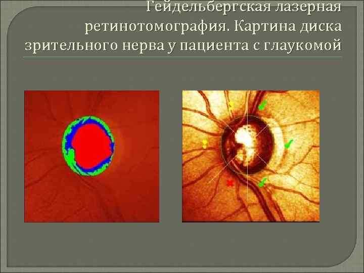 Гейдельбергская лазерная ретинотомография. Картина диска зрительного нерва у пациента с глаукомой 