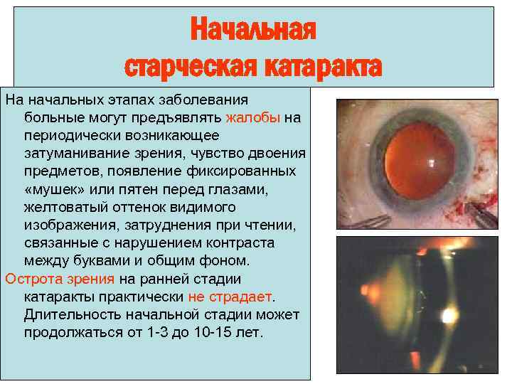 Начальная старческая катаракта На начальных этапах заболевания больные могут предъявлять жалобы на периодически возникающее