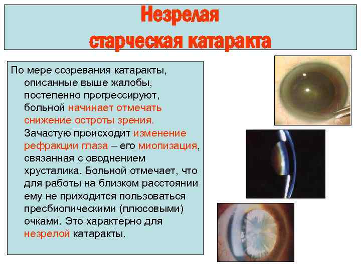 Незрелая старческая катаракта По мере созревания катаракты, описанные выше жалобы, постепенно прогрессируют, больной начинает