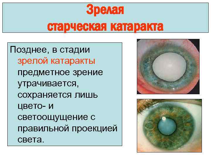 Зрелая старческая катаракта Позднее, в стадии зрелой катаракты предметное зрение утрачивается, сохраняется лишь цвето-