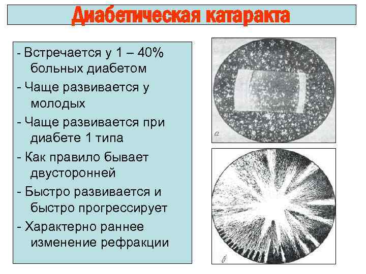 Диабетическая катаракта - Встречается у 1 – 40% больных диабетом - Чаще развивается у