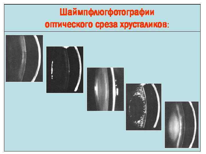 Шаймпфлюгфотографии оптического среза хрусталиков: 