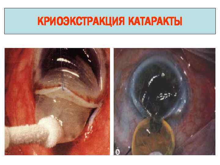 КРИОЭКСТРАКЦИЯ КАТАРАКТЫ 