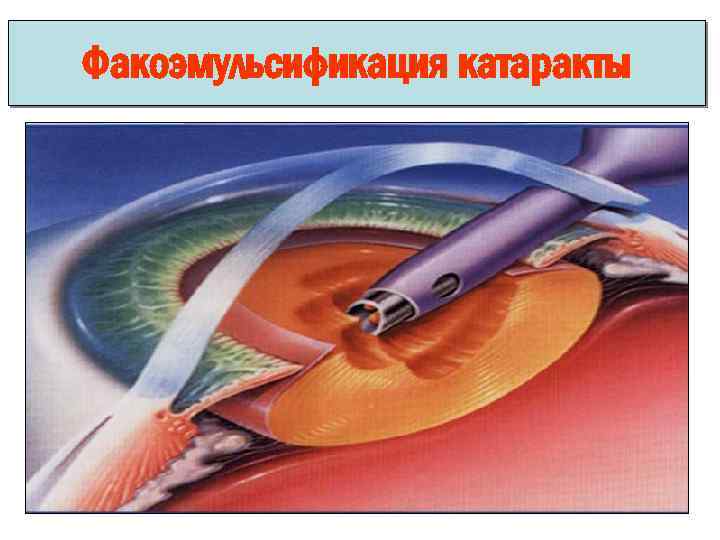 Факоэмульсификация катаракты 
