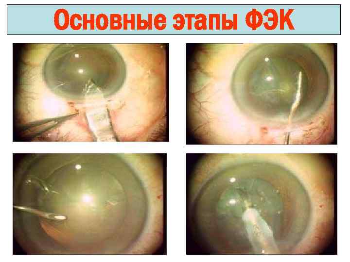 Основные этапы ФЭК 