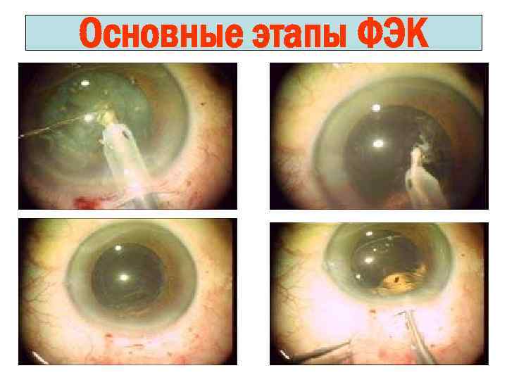 Основные этапы ФЭК 