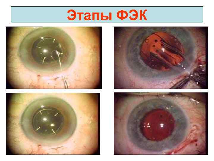 Этапы ФЭК 