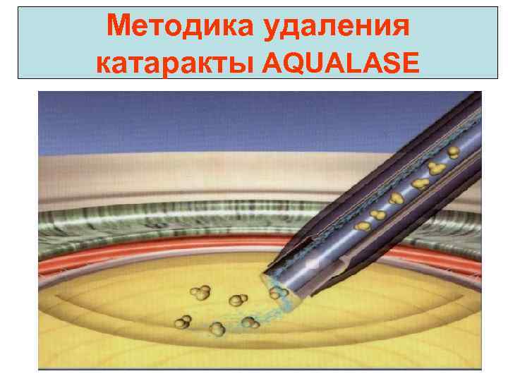 Методика удаления катаракты AQUALASE 