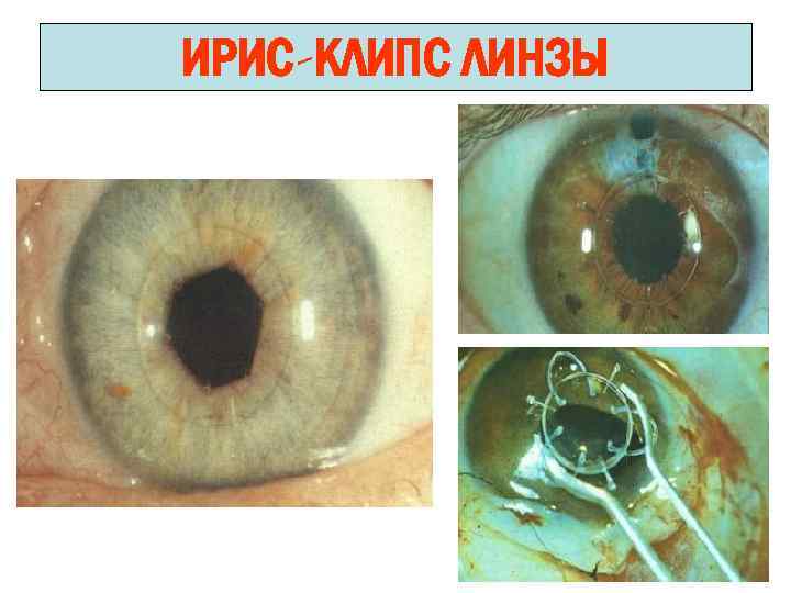 ИРИС-КЛИПС ЛИНЗЫ 