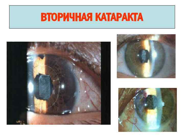 ВТОРИЧНАЯ КАТАРАКТА 