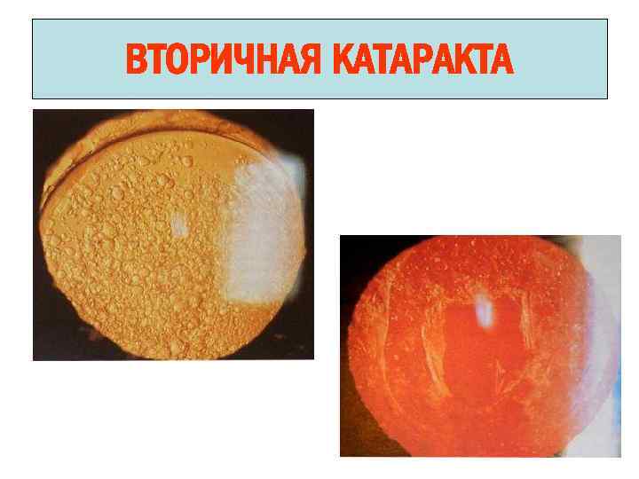 ВТОРИЧНАЯ КАТАРАКТА 