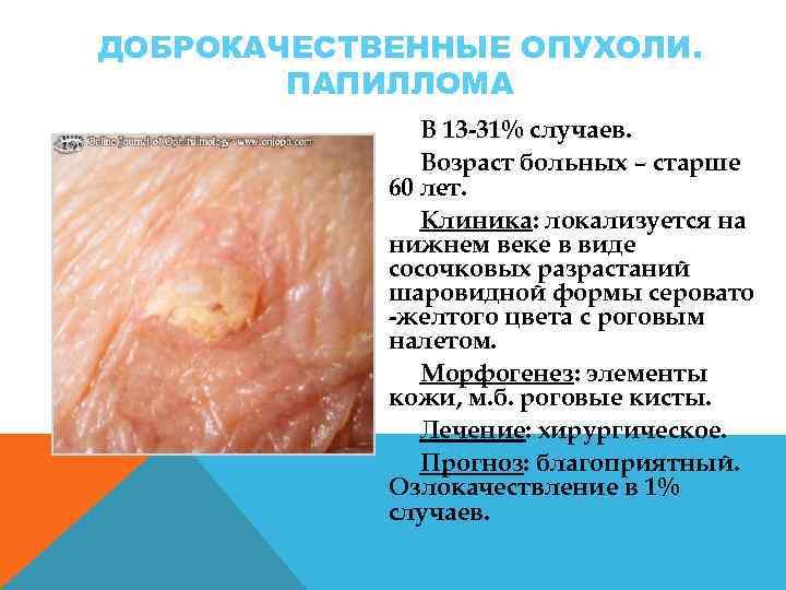 ДОБРОКАЧЕСТВЕННЫЕ ОПУХОЛИ. ПАПИЛЛОМА В 13 31% случаев. Возраст больных – старше 60 лет. Клиника: