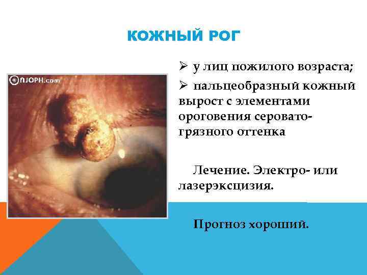 КОЖНЫЙ РОГ Ø у лиц пожилого возраста; Ø пальцеобразный кожный вырост с элементами ороговения