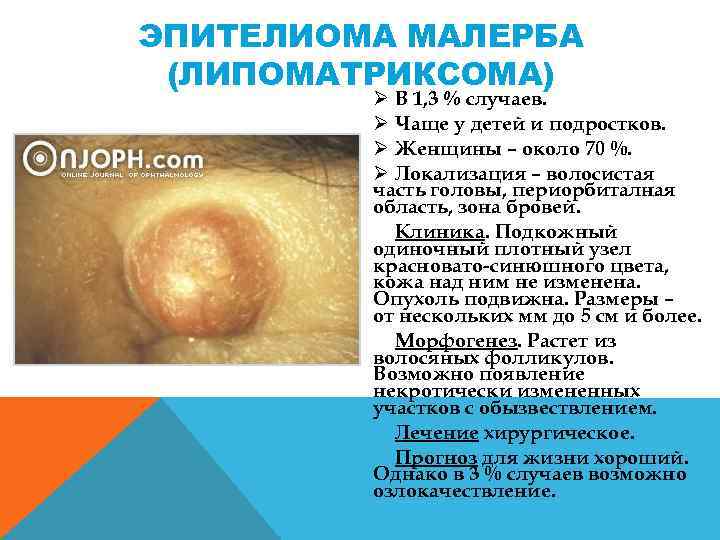 ЭПИТЕЛИОМА МАЛЕРБА (ЛИПОМАТРИКСОМА) Ø В 1, 3 % случаев. Ø Чаще у детей и