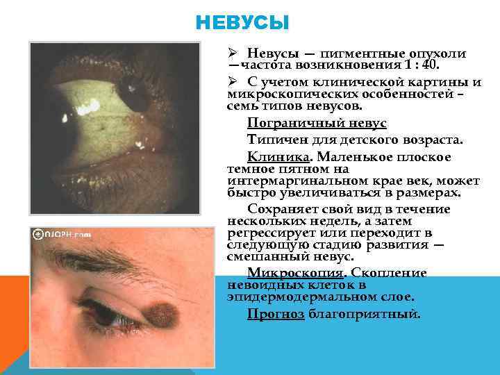 НЕВУСЫ Ø Невусы — пигментные опухоли —частота возникновения 1 : 40. Ø С учетом