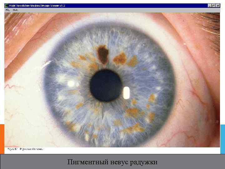 Пигментный невус радужки 