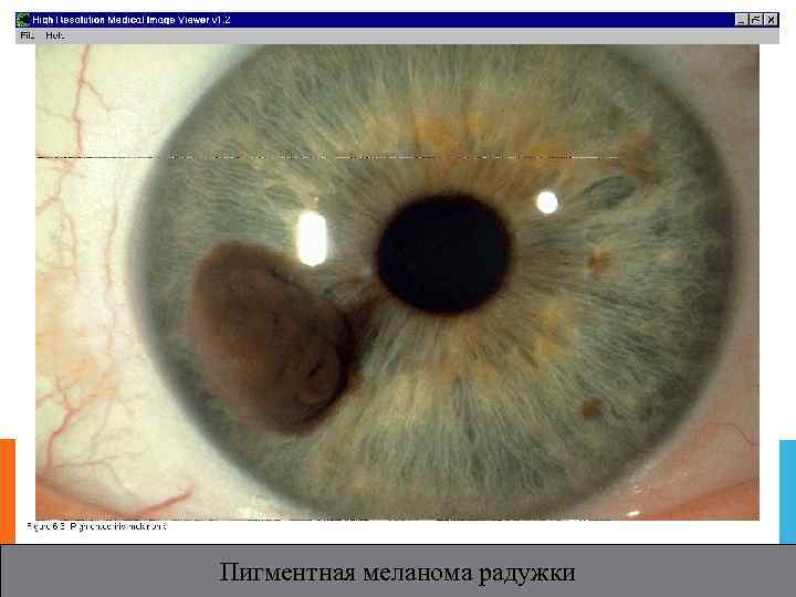 Пигментная меланома радужки 