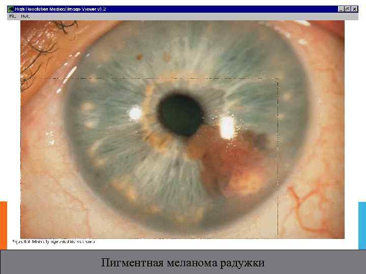 Пигментная меланома радужки 
