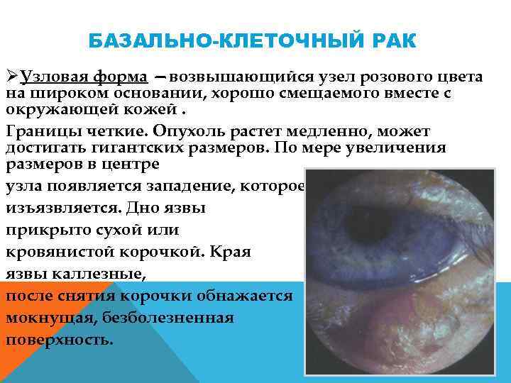 БАЗАЛЬНО-КЛЕТОЧНЫЙ РАК ØУзловая форма —возвышающийся узел розового цвета на широком основании, хорошо смещаемого вместе