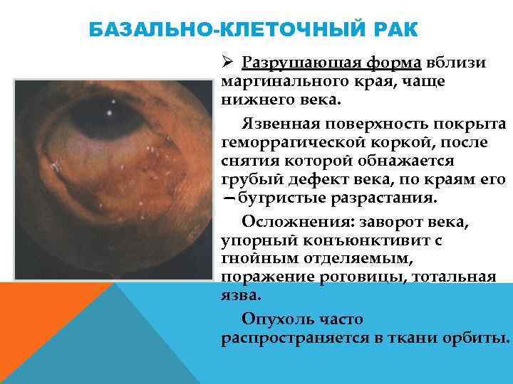 БАЗАЛЬНО-КЛЕТОЧНЫЙ РАК Ø Разрушающая форма вблизи маргинального края, чаще нижнего века. Язвенная поверхность покрыта
