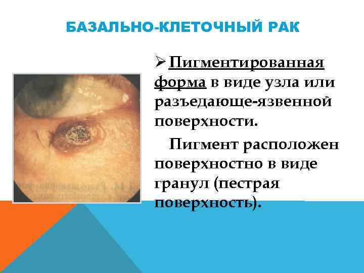БАЗАЛЬНО-КЛЕТОЧНЫЙ РАК Ø Пигментированная форма в виде узла или разъедающе язвенной поверхности. Пигмент расположен