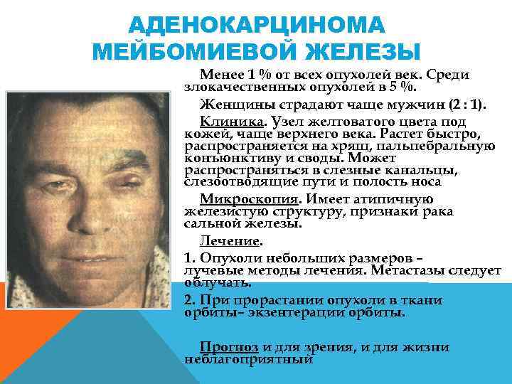 АДЕНОКАРЦИНОМА МЕЙБОМИЕВОЙ ЖЕЛЕЗЫ Менее 1 % от всех опухолей век. Среди злокачественных опухолей в