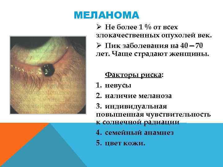 МЕЛАНОМА Ø Не более 1 % от всех злокачественных опухолей век. Ø Пик заболевания