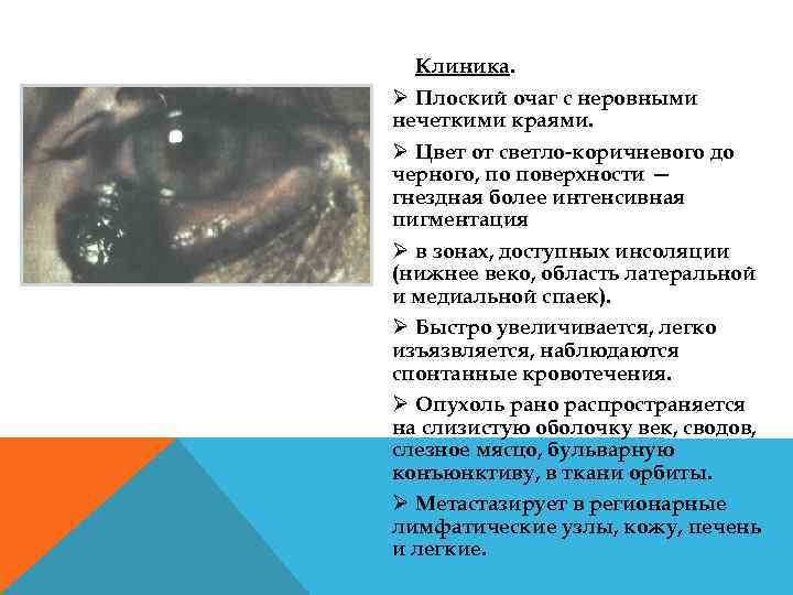 Клиника. Ø Плоский очаг с неровными нечеткими краями. Ø Цвет от светло коричневого до