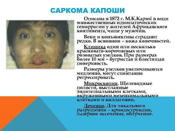 САРКОМА КАПОШИ Описана в 1872 г. M. K. Kaposi в виде множественных идиопатических геморрагии