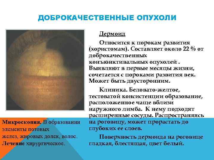 ДОБРОКАЧЕСТВЕННЫЕ ОПУХОЛИ Микроскопия. В образовании элементы потовых желез, жировых долек, волос. Лечение хирургическое. Дермоид