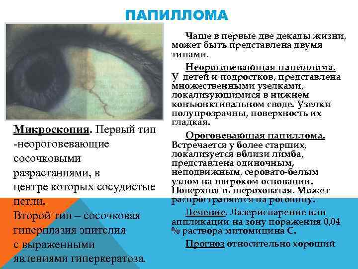 ПАПИЛЛОМА Чаще в первые две декады жизни, может быть представлена двумя типами. Неороговевающая папиллома.