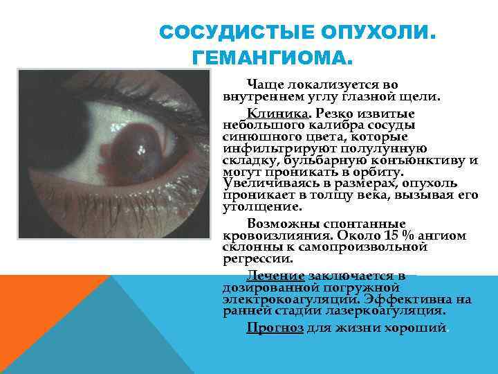 СОСУДИСТЫЕ ОПУХОЛИ ГЕМАНГИОМА. Чаще локализуется во внутреннем углу глазной щели. Клиника. Резко извитые небольшого